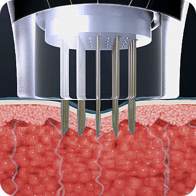 Potenza_Invasive_01