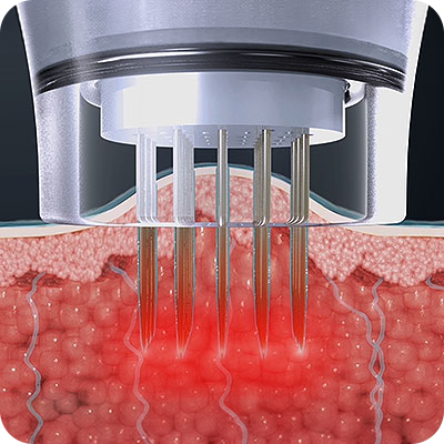 Potenza_Invasive_02