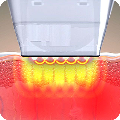 Potenza_Non-Invasive_03