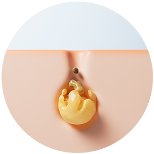 acne_icon01