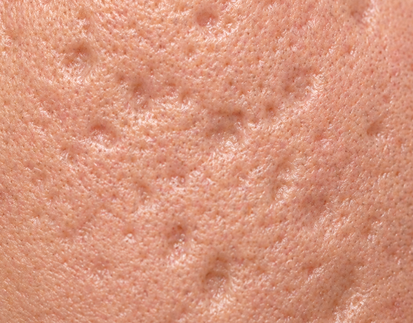 acne_image_05-3