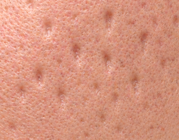 acne_image_06-1