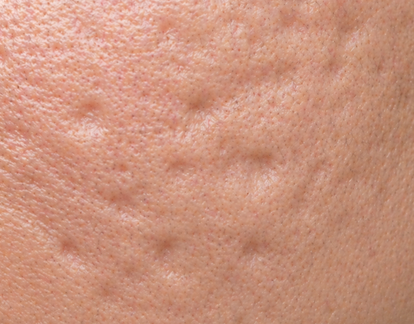 acne_image_07-1