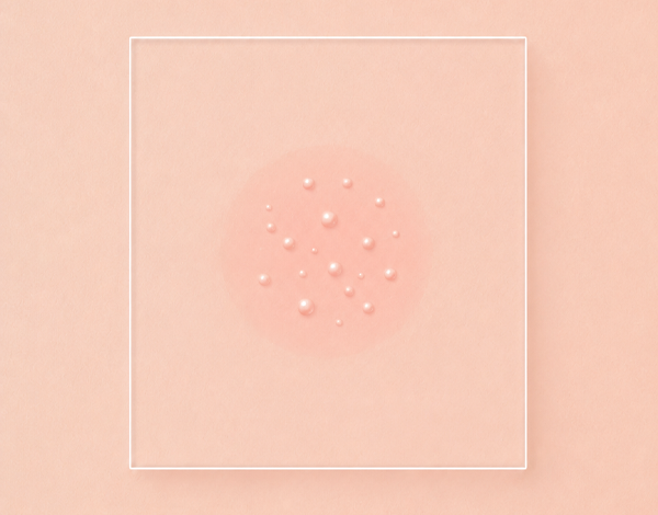 acne_0523_icon_01